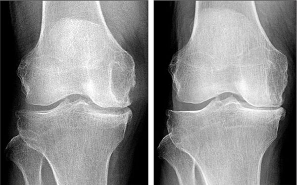 antes e despois do tratamento da artrose con Hondrofrost