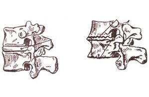 Etapas do desenvolvemento da osteocondrose torácica