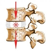 O dispositivo da columna vertebral e as causas da osteocondrose