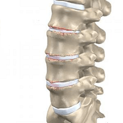 danos ás vértebras na osteocondrose lumbar