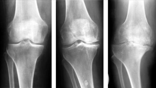 3 etapas da artrose da articulación do xeonllo